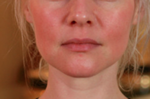 Rosacea Treatment | Skin Medical 