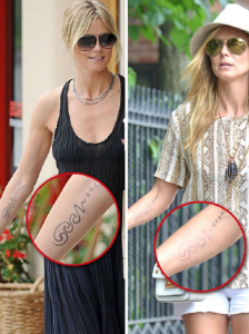 laser tattoo removal | tattoo removal