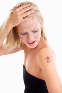 laser tattoo removal
