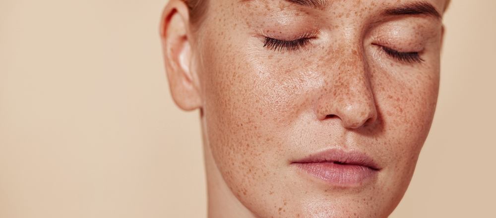 Skin Pigmentation Treatment in Manchester | Skin Medical